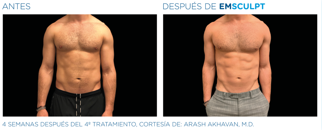 emsculpt abdomen