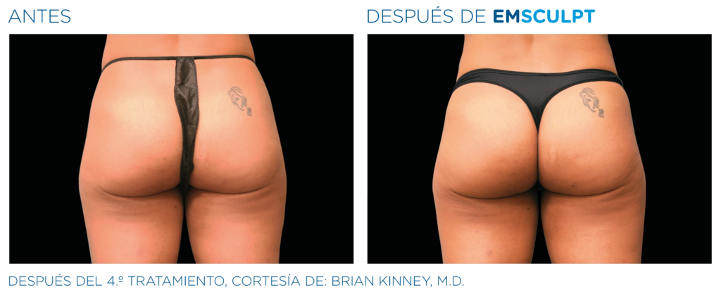 Emsculpt gluteos 5 tonificacion gluteos